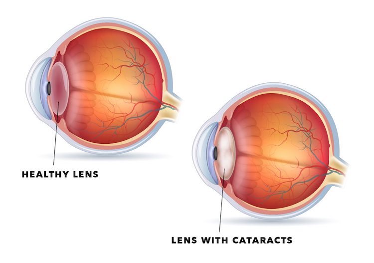 cataract