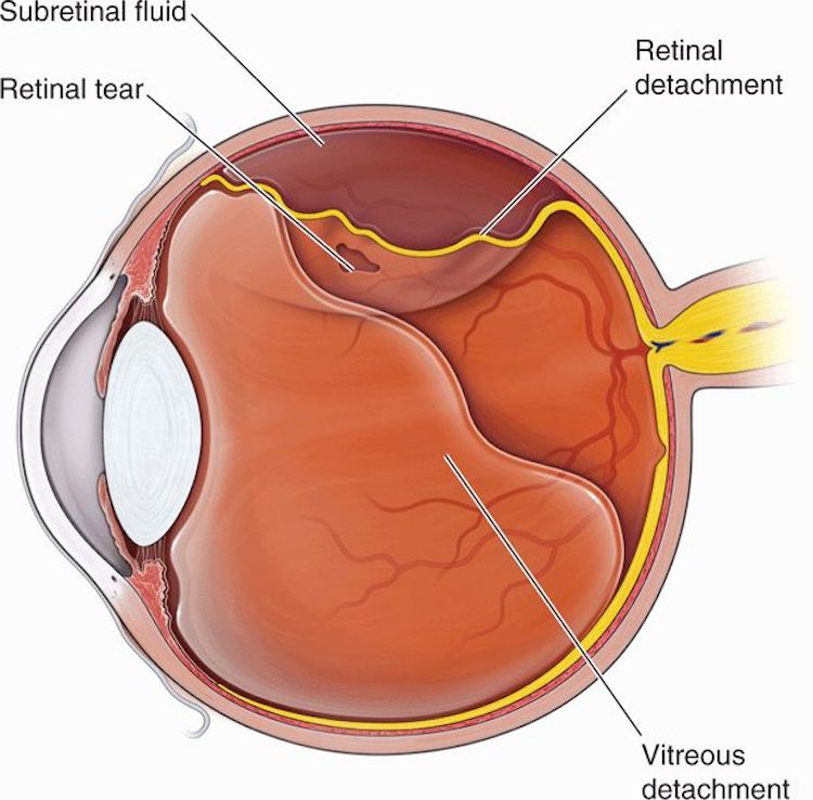 retina detachment surgery gas airplanes blindness